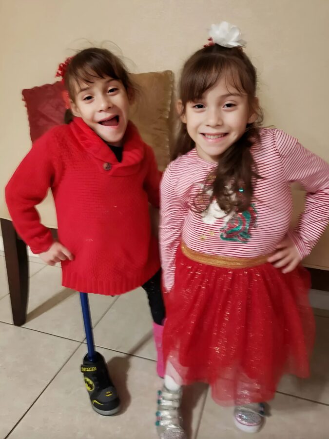 ორი სიამური და გადაურჩა მაღალრისკიან ოპერაციას და ახლა ცალ-ცალკე აგრძელებენ ცხოვრებას