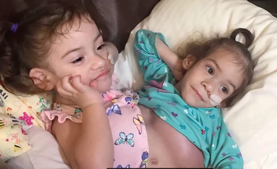 ორი სიამური და გადაურჩა მაღალრისკიან ოპერაციას და ახლა ცალ-ცალკე აგრძელებენ ცხოვრებას