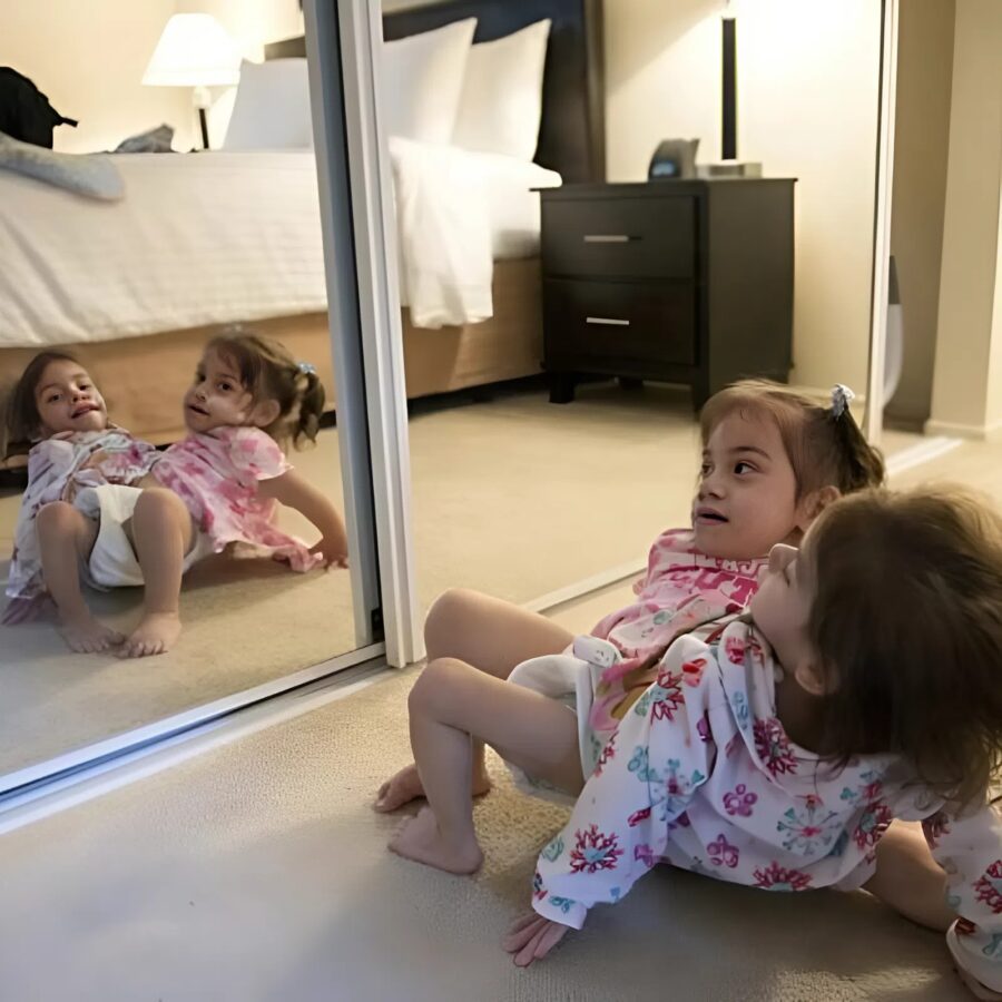 ორი სიამური და გადაურჩა მაღალრისკიან ოპერაციას და ახლა ცალ-ცალკე აგრძელებენ ცხოვრებას